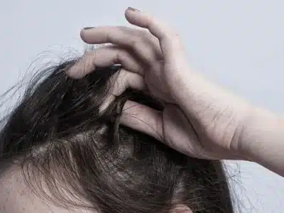 pulling out hair trichotillomania