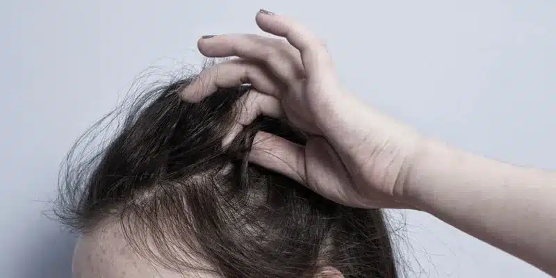 pulling out hair trichotillomania