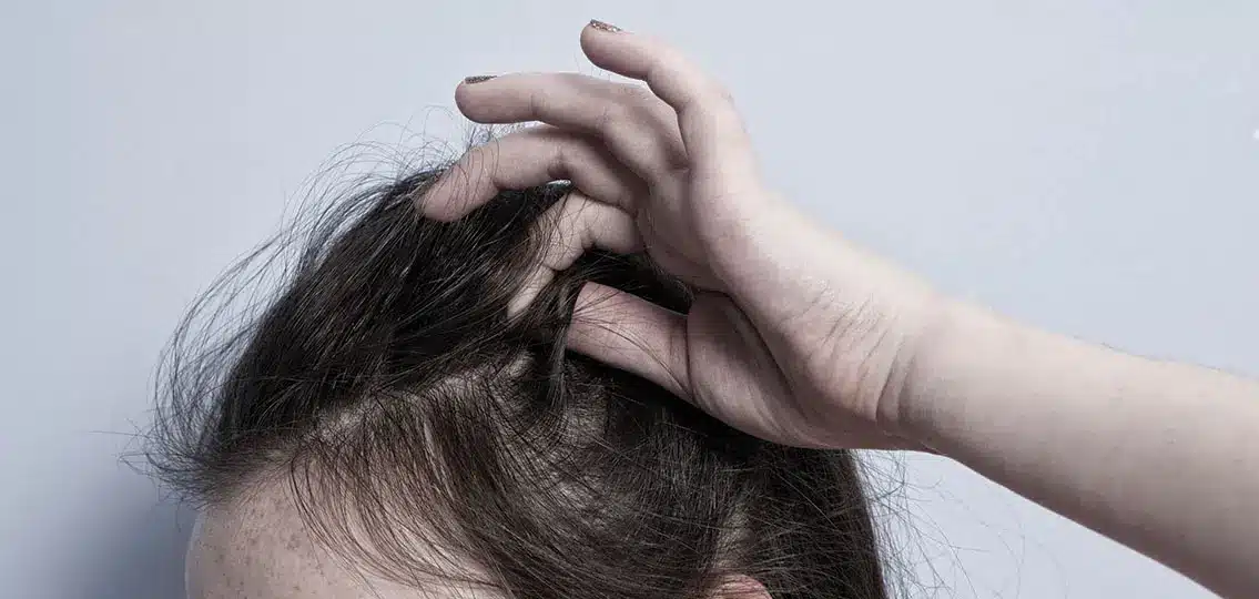 pulling out hair trichotillomania