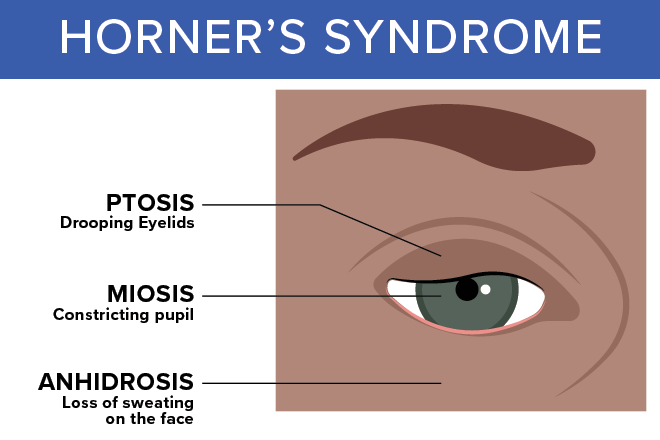 Horner s Syndrome Anatomy