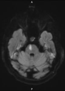 Acute infarct showing restricted diffusion is noted involving right half of pons in a patient diagnosed with Foville Syndrome [12].