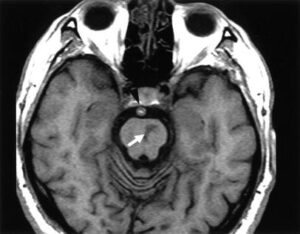 MR imaging revealing an infarct in the left side of the ventral pons in a patient diagnosed with Millard Gubler.