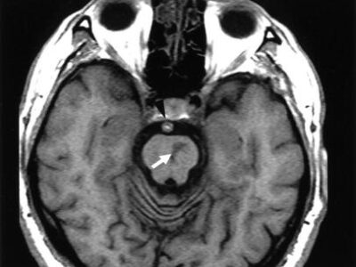 MR imaging revealed an infarct in the left side of the ventral pons in a patient diagnosed with Millard Gubler.