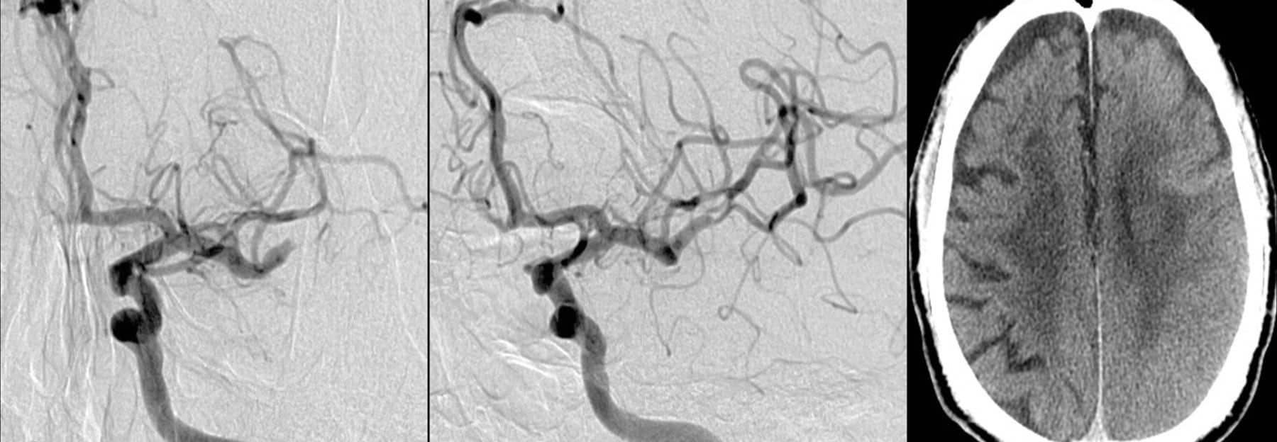 Cerebral Hyperperfusion Syndrome - Neuropedia