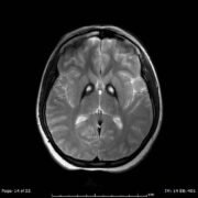 Fig. 1: T2-weighted MRI showing bilateral iron deposition at the basal ganglia - "Eye-of-the-Tiger" sign [3].