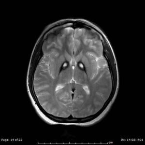 Fig. 1: T2-weighted MRI showing bilateral iron deposition at the basal ganglia - "Eye-of-the-Tiger" sign [3].