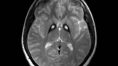 Fig. 1: T2-weighted MRI showing bilateral iron deposition at the basal ganglia - "Eye-of-the-Tiger" sign [3].