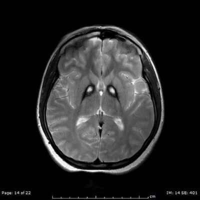 Fig. 1: T2-weighted MRI showing bilateral iron deposition at the basal ganglia - "Eye-of-the-Tiger" sign [3].