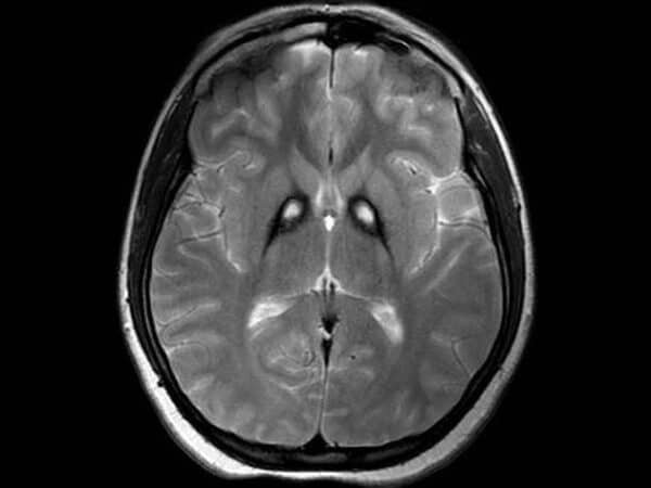 Fig. 1: T2-weighted MRI showing bilateral iron deposition at the basal ganglia - "Eye-of-the-Tiger" sign [3].