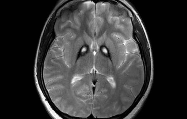 Fig. 1: T2-weighted MRI showing bilateral iron deposition at the basal ganglia - "Eye-of-the-Tiger" sign [3].