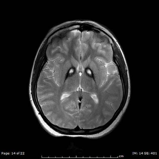 Fig. 1: T2-weighted MRI showing bilateral iron deposition at the basal ganglia - "Eye-of-the-Tiger" sign [3].