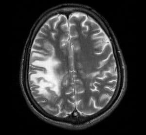 Figure 1: PML under MRI2                                                     