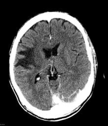 Figure 5: Axial CT of the brain demonstrates a large area of low attenuation in the right hemisphere, without evidence of contrast enhancement. It affects the white matter, sparing the cortex.15